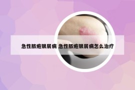 急性脓疱银屑病 急性脓疱银屑病怎么治疗