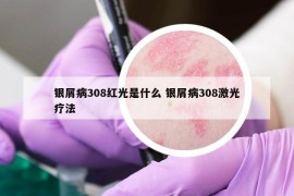 银屑病308红光是什么 银屑病308激光疗法