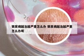 银屑病越治越严重怎么办 银屑病越治越严重怎么办呢