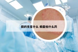 藓的克星什么 癣最怕什么药