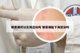 银屑病可以去海边玩吗 银屑病能下海游泳吗