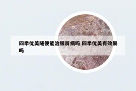 四季优美随便能治银屑病吗 四季优美有效果吗