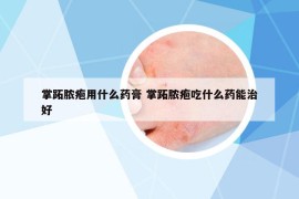 掌跖脓疱用什么药膏 掌跖脓疱吃什么药能治好