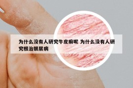 为什么没有人研究牛皮癣呢 为什么没有人研究根治银屑病