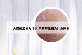 头皮癣是因为什么 头皮癣是因为什么原因