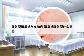 寻常型银屑病与皮肤癌 银屑病寻常型什么意思