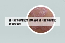 扎针排淤拔罐能治银屑病吗 扎针排淤拔罐能治银屑病吗