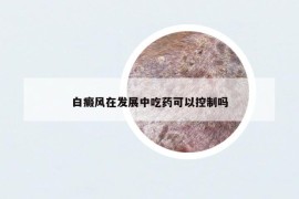 白癜风在发展中吃药可以控制吗