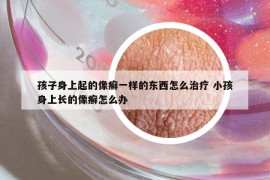 孩子身上起的像癣一样的东西怎么治疗 小孩身上长的像癣怎么办