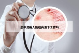 患牛皮癣人能在高温下工作吗