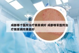 成都那个医院治疗银屑病好 成都哪家医院治疗银屑病效果最好