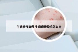 牛癖癣传染吗 牛癖癣传染吗怎么治