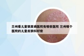 兰州看儿童银屑病医院有哪些医院 兰州哪个医院的儿童皮肤科好些