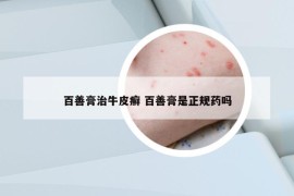 百善膏治牛皮癣 百善膏是正规药吗