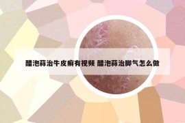 醋泡蒜治牛皮癣有视频 醋泡蒜治脚气怎么做