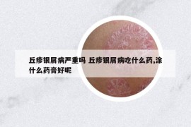 丘疹银屑病严重吗 丘疹银屑病吃什么药,涂什么药膏好呢