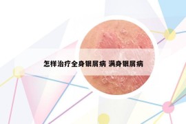 怎样治疗全身银屑病 满身银屑病