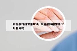 银屑病抹维生素D3吗 银屑病抹维生素d3吗有用吗