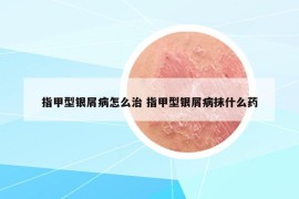 指甲型银屑病怎么治 指甲型银屑病抹什么药