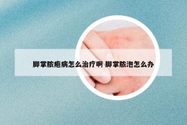 脚掌脓疱病怎么治疗啊 脚掌脓泡怎么办