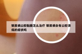 银屑病口腔黏膜怎么治疗 银屑病会有口腔溃疡的症状吗