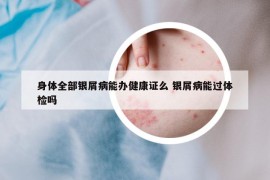 身体全部银屑病能办健康证么 银屑病能过体检吗