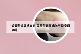 关节型银屑病自愈 关节型银屑病关节能变回来吗