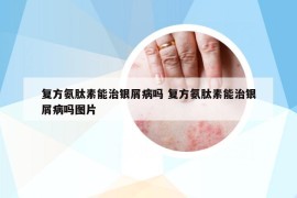 复方氨肽素能治银屑病吗 复方氨肽素能治银屑病吗图片