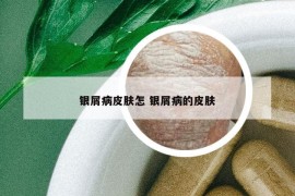 银屑病皮肤怎 银屑病的皮肤