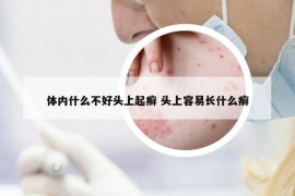 体内什么不好头上起癣 头上容易长什么癣