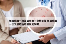 银屑病第一次发病咋治不容易复发 银屑病第一次发病咋治不容易复发呢