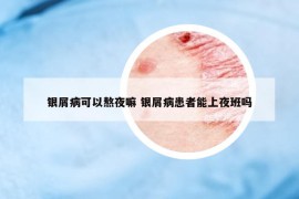 银屑病可以熬夜嘛 银屑病患者能上夜班吗