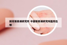 国家银屑病研究院 中国银屑病研究所医院在哪