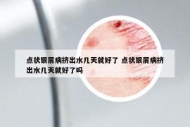 点状银屑病挤出水几天就好了 点状银屑病挤出水几天就好了吗