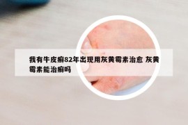 我有牛皮癣82年出现用灰黄霉素治愈 灰黄霉素能治癣吗