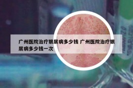 广州医院治疗银屑病多少钱 广州医院治疗银屑病多少钱一次