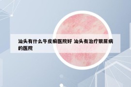 汕头有什么牛皮癣医院好 汕头有治疗银屑病的医院