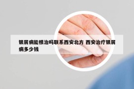 银屑病能根治吗联系西安北方 西安治疗银屑病多少钱