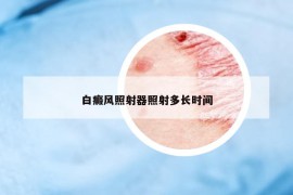 白癜风照射器照射多长时间