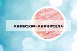 银屑病能吃芡实吗 银屑病可以吃薏米吗