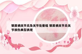 银屑病关节炎及关节处萎缩 银屑病关节炎关节损伤典型表现