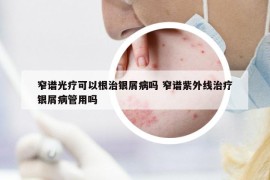 窄谱光疗可以根治银屑病吗 窄谱紫外线治疗银屑病管用吗