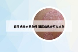 银屑病能吃黑鱼吗 银屑病患者可以吃鱼