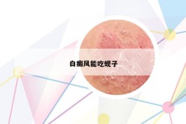 白癜风能吃蚬子