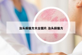 治头癣偏方大全图片 治头藓偏方