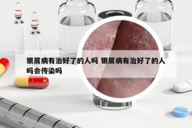 银屑病有治好了的人吗 银屑病有治好了的人吗会传染吗