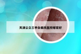 天津公立三甲白癜风医院哪家好