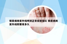 银屑病用紫外线烤到正常皮肤变红 银屑病用紫外线照要用多久