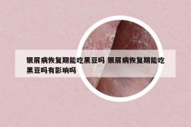 银屑病恢复期能吃黑豆吗 银屑病恢复期能吃黑豆吗有影响吗