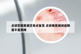 点状型银屑病又有点复发 点状银屑病消退期是不是很痒